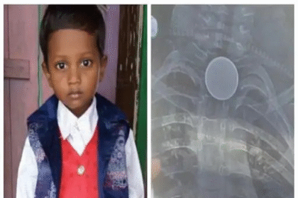 Death by swallowing a coin